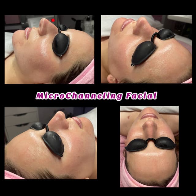 Microchanneling Pack of 3