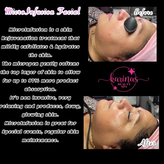 Microinfusion Facial Pack Of 3